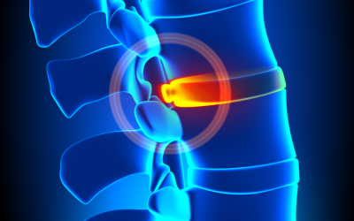 Can a Chiropractor Fix a Bulging Disk?