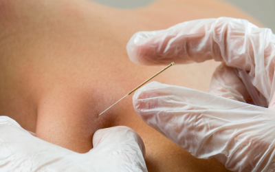 Dry Needling vs. Acupuncture: Understanding the Differences