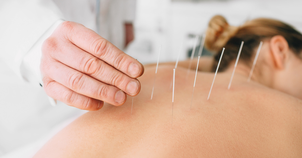 Dry Needling vs. Acupuncture: Understanding the Differences - Nobility ...