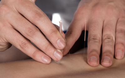 The Role of Acupuncture For Treating Migraines