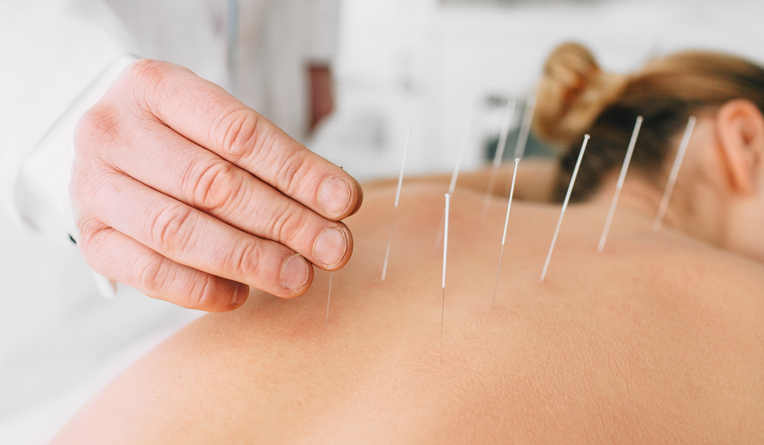 Can Acupuncture Improve Sleep Quality?