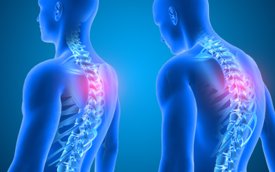 Can Bad Posture Cause Scoliosis?