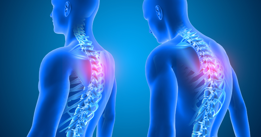 Can Bad Posture Cause Scoliosis?