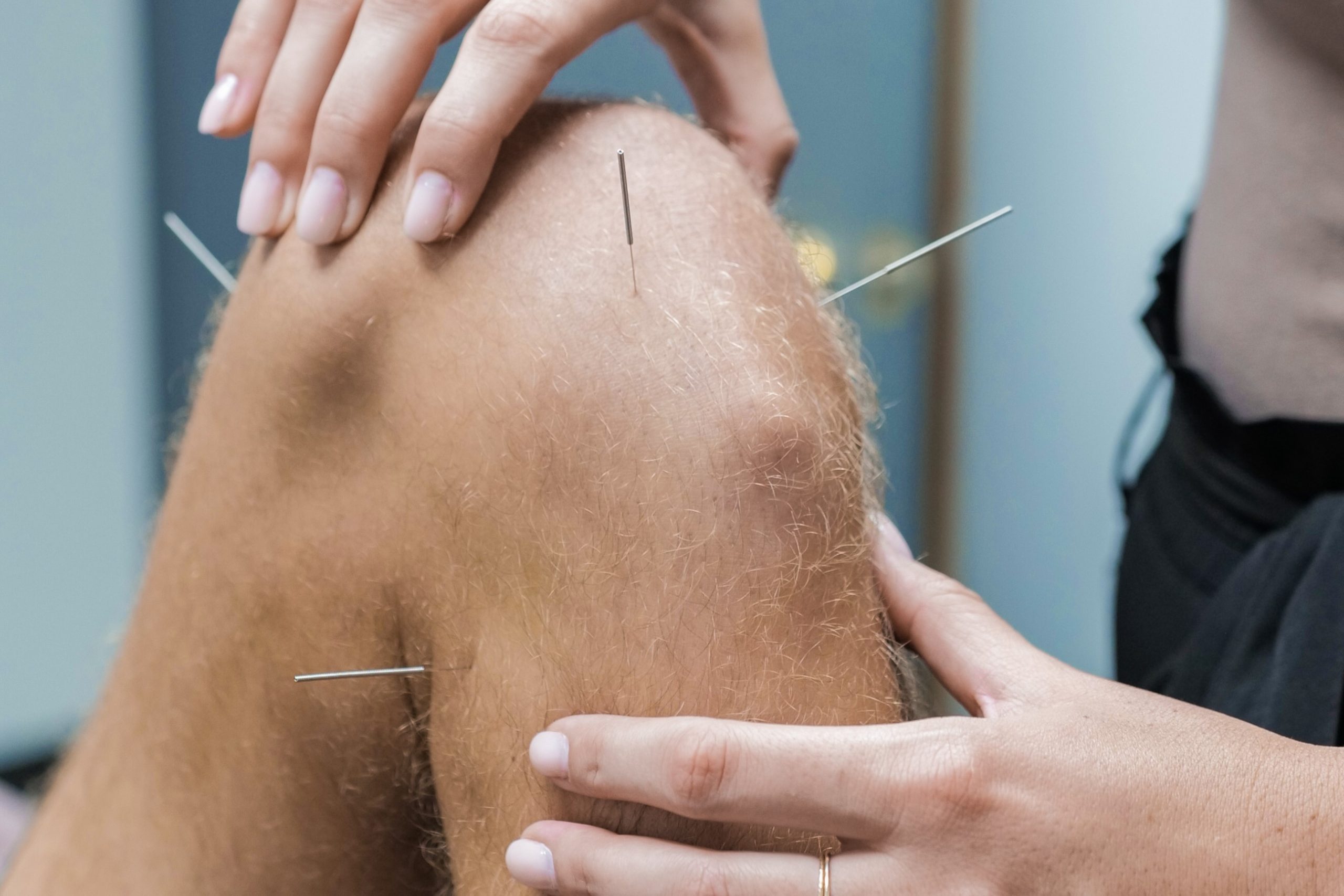A patient receives acupuncture for knee pain. 