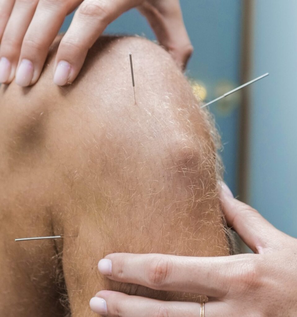 Acupuncture and dry needling treatment at Nobility Chiropractic in Smiths Falls
